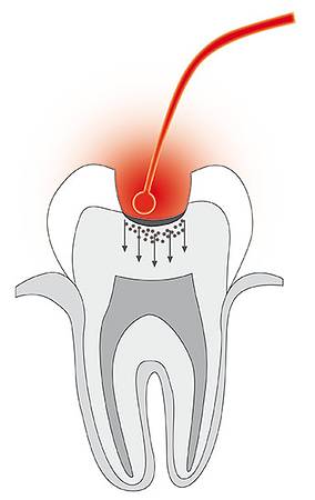 Bild Kariestherapie / © Cumdente Bild Kariestherapie / © Cumdente